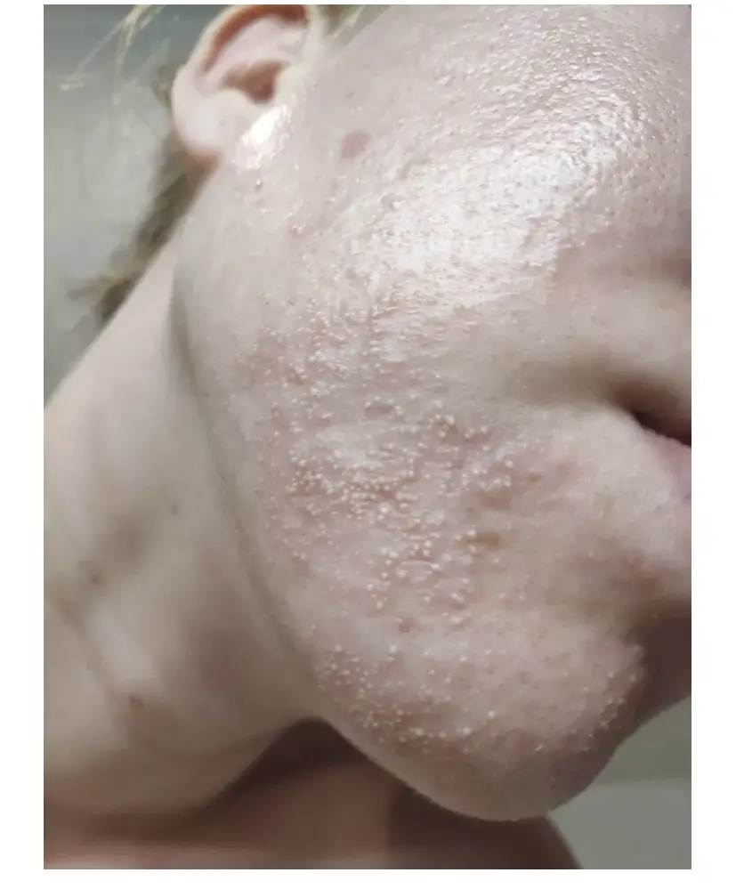 Skin showing fungal acne