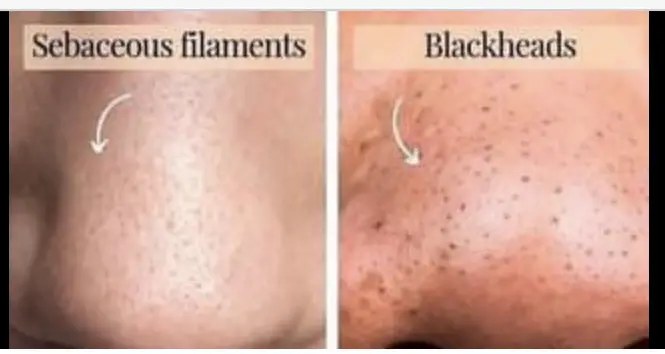 Sebaceous filament versus blackheads 