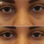 Under eye filler: Everything you need to know: Cost, side effects, how it works
