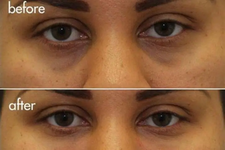 Under eye filler: Everything you need to know: Cost, side effects, how it works