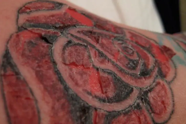 How to know your tattoo is infected and how to treat it