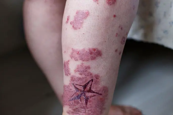 picture of an infected tattoo
