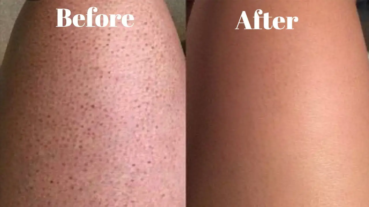 strawberry legs treatment