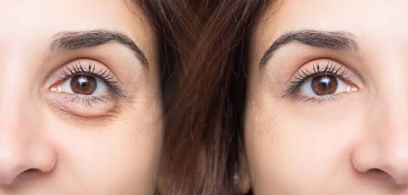 how to get rid of Eye bags