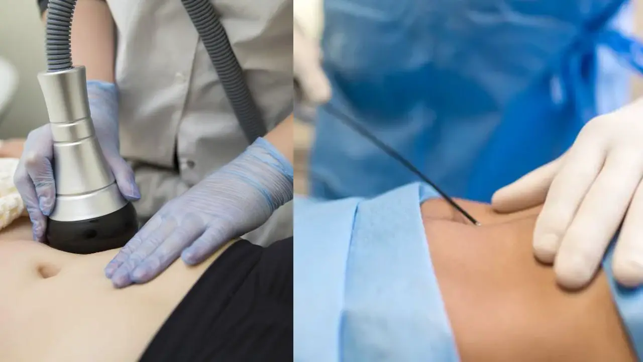 Smart lipo procedure cosmetics surgery