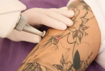 Tattoo removal cost